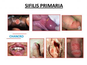 20140206-sifilis-primaria-7-638
